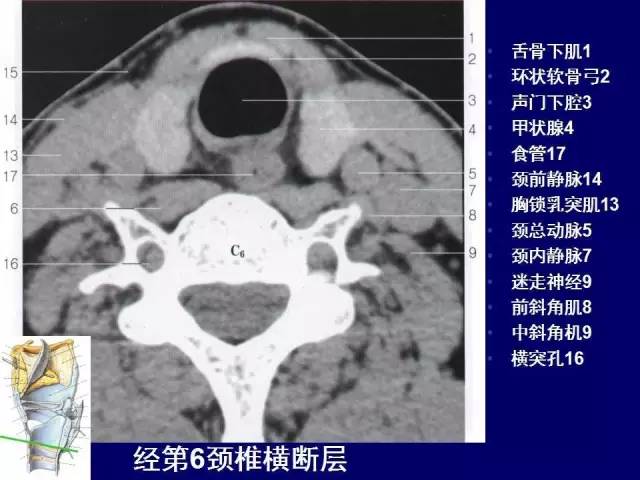 影像PPT - 【PPT】颈部和喉的断层解剖-56
