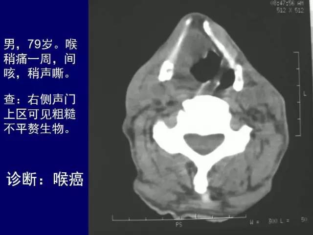 影像PPT - 【PPT】颈部和喉的断层解剖-57