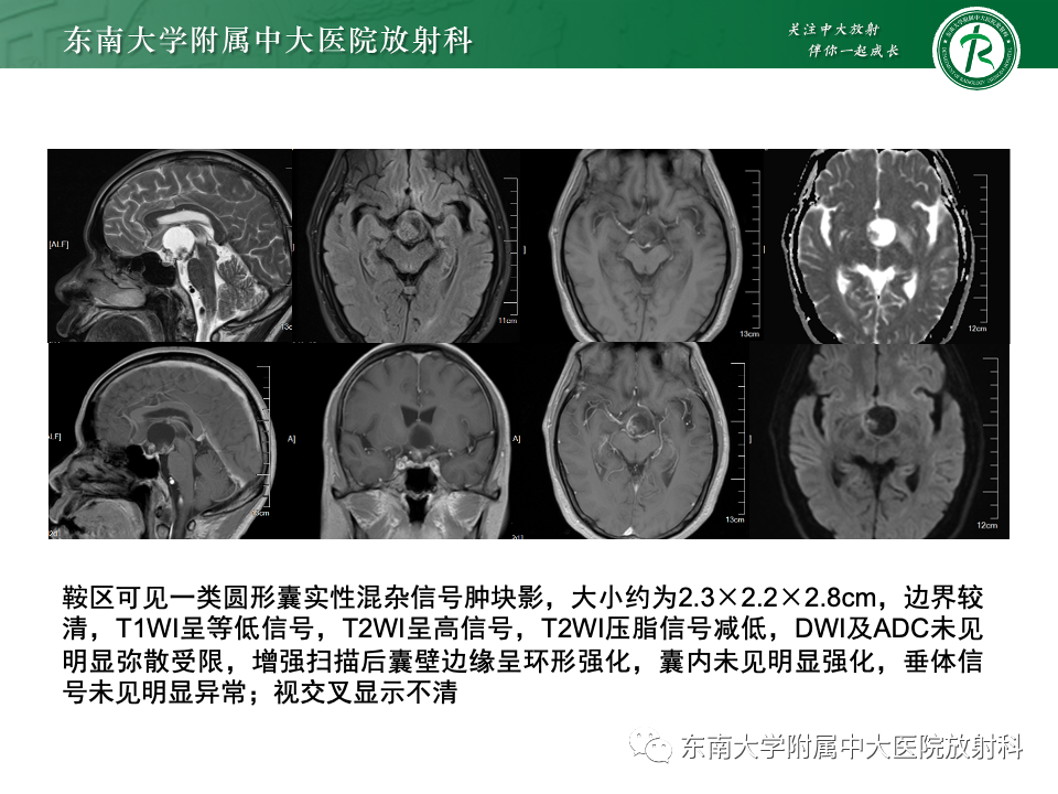 影像PPT - 【PPT】颅咽管瘤-4