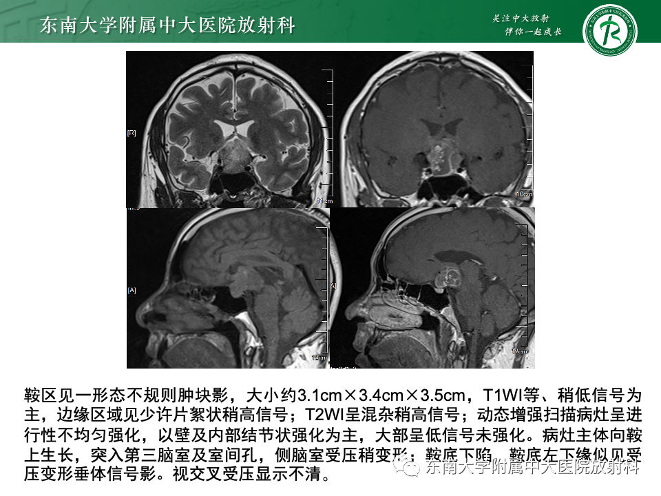 影像PPT - 【PPT】颅咽管瘤-16