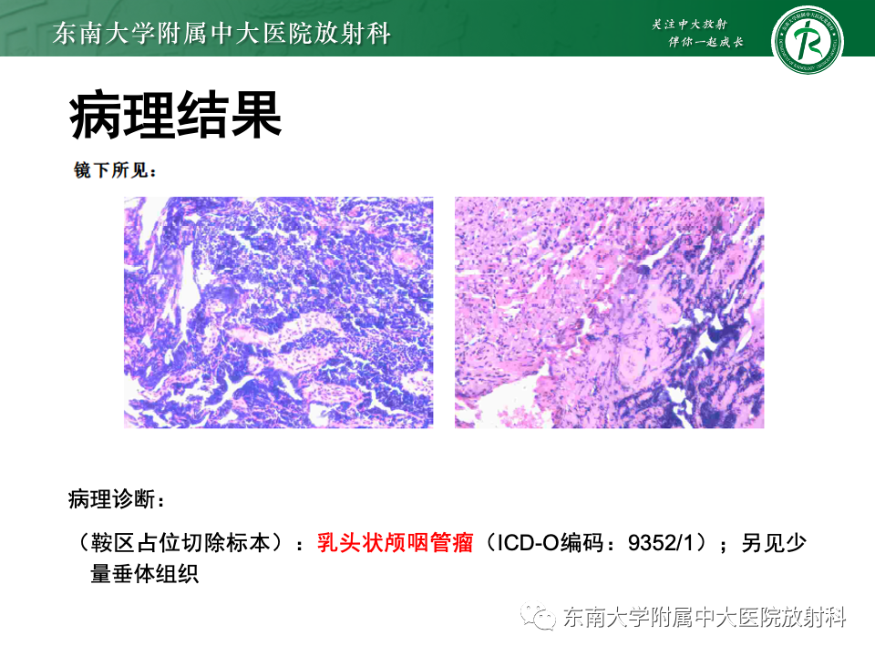 影像PPT - 【PPT】颅咽管瘤-17