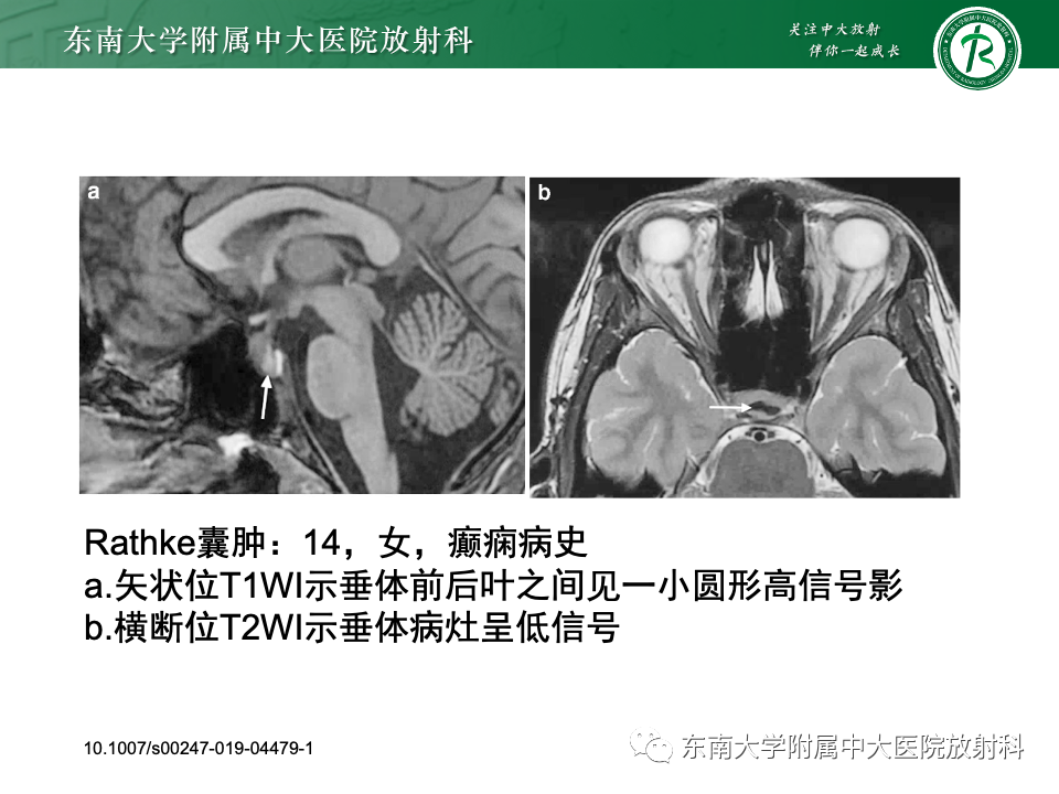 影像PPT - 【PPT】颅咽管瘤-21