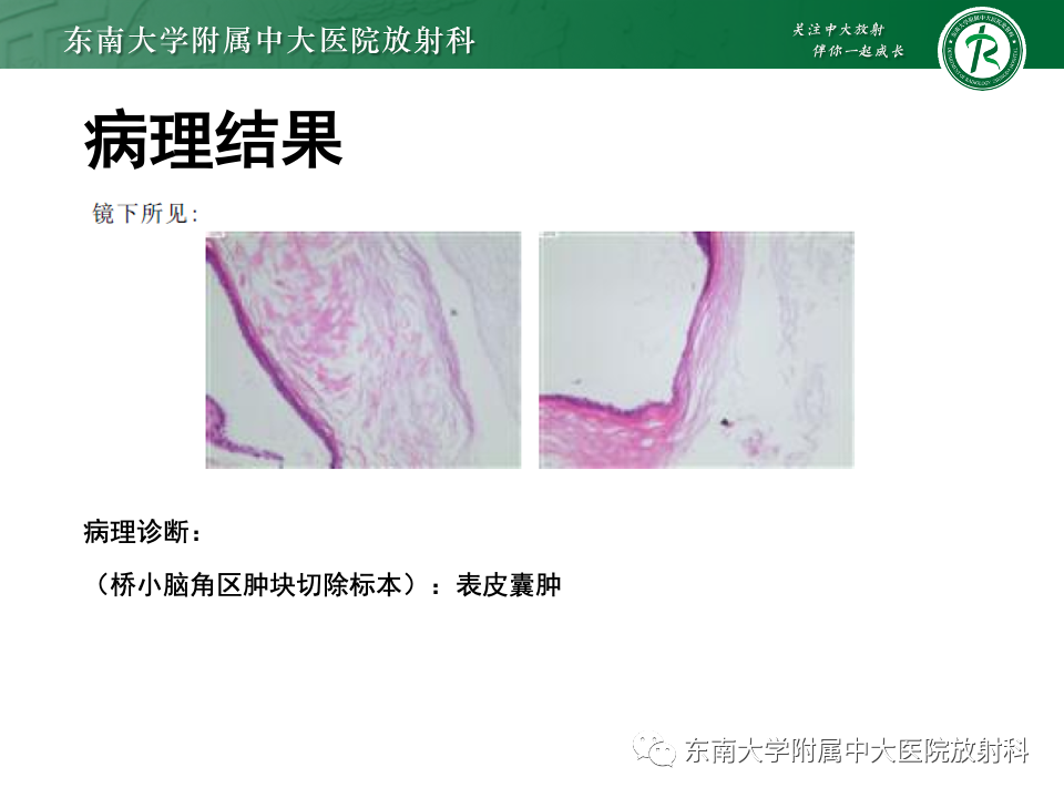 影像PPT - 【PPT】颅咽管瘤-26