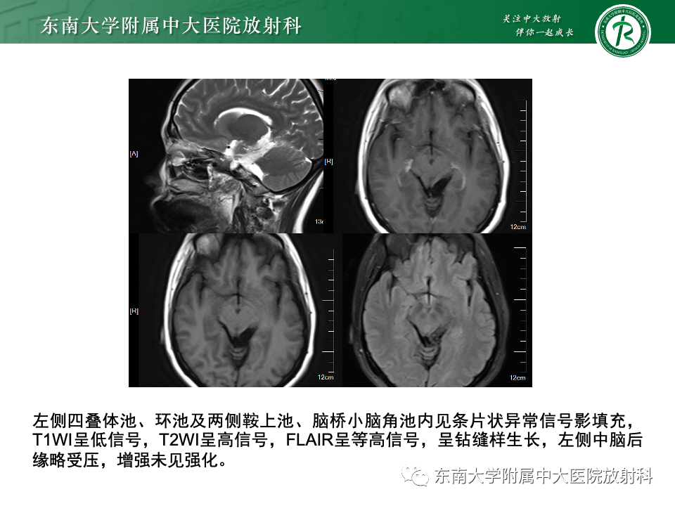 影像PPT - 【PPT】颅咽管瘤-25