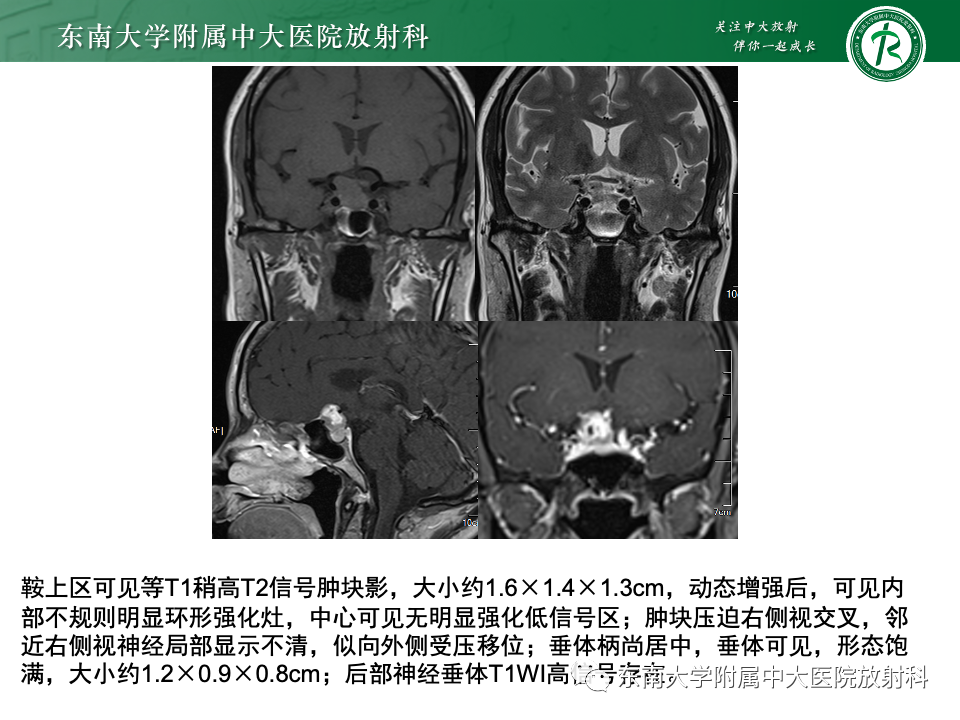 影像PPT - 【PPT】颅咽管瘤-34