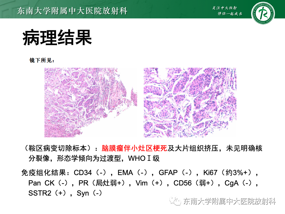 影像PPT - 【PPT】颅咽管瘤-35