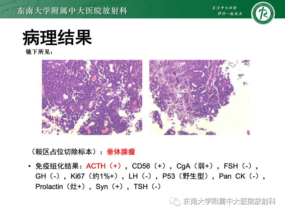 影像PPT - 【PPT】颅咽管瘤-31
