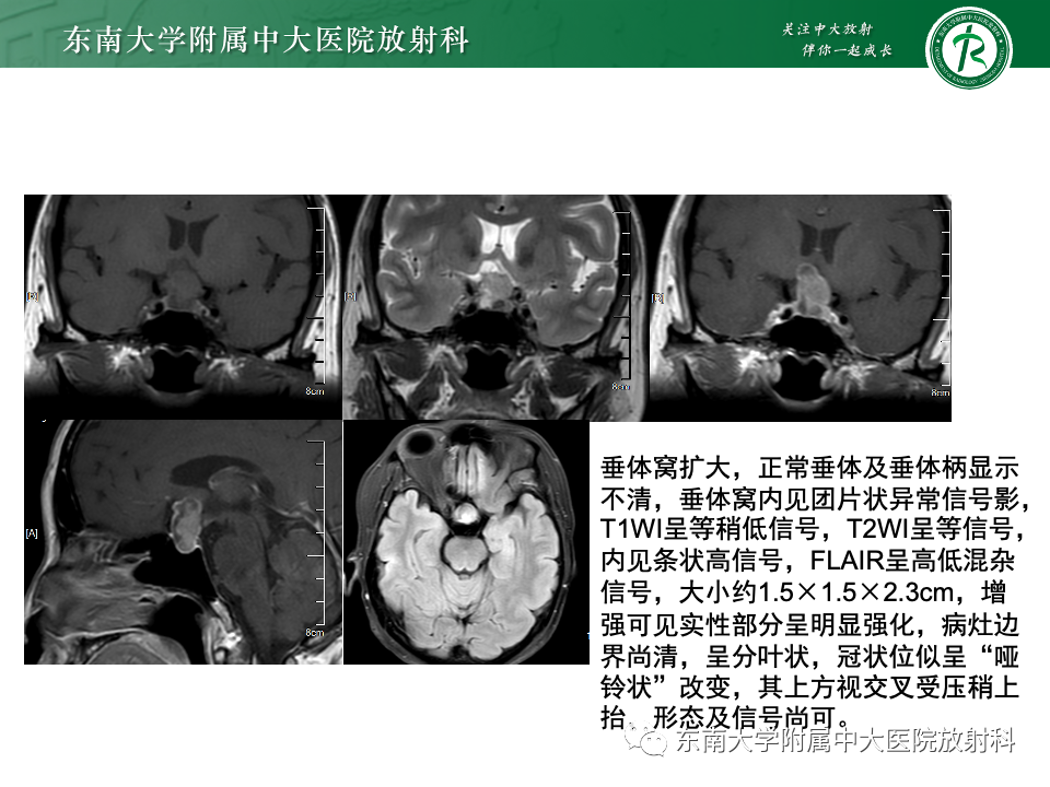 影像PPT - 【PPT】颅咽管瘤-30