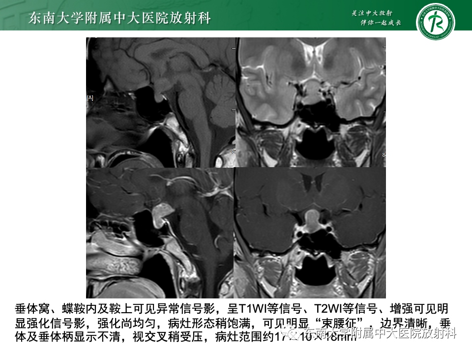 影像PPT - 【PPT】颅咽管瘤-39