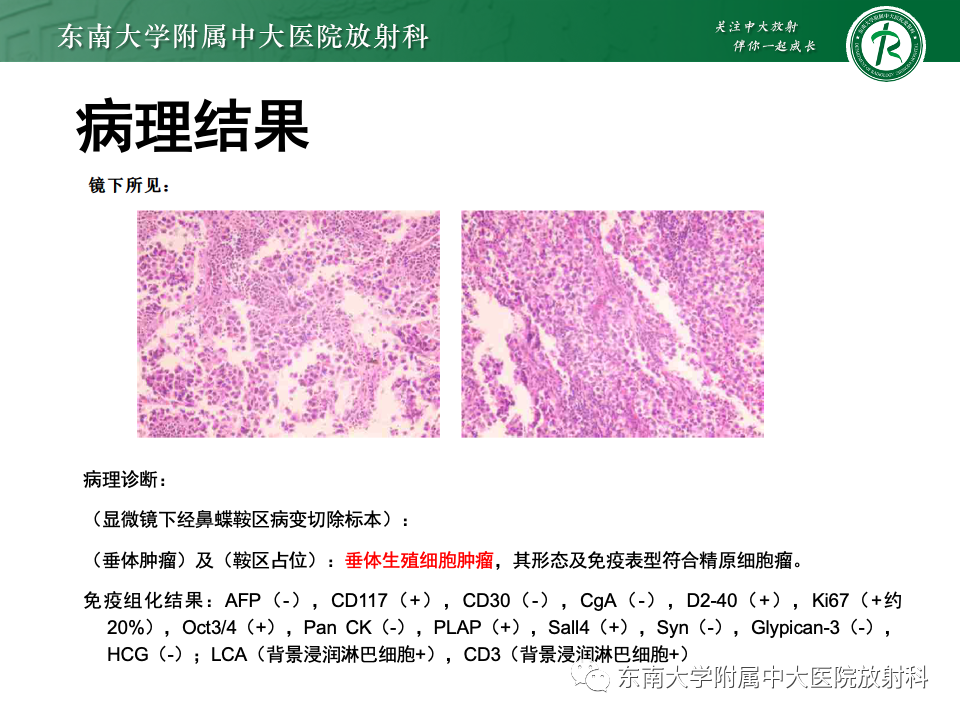 影像PPT - 【PPT】颅咽管瘤-40