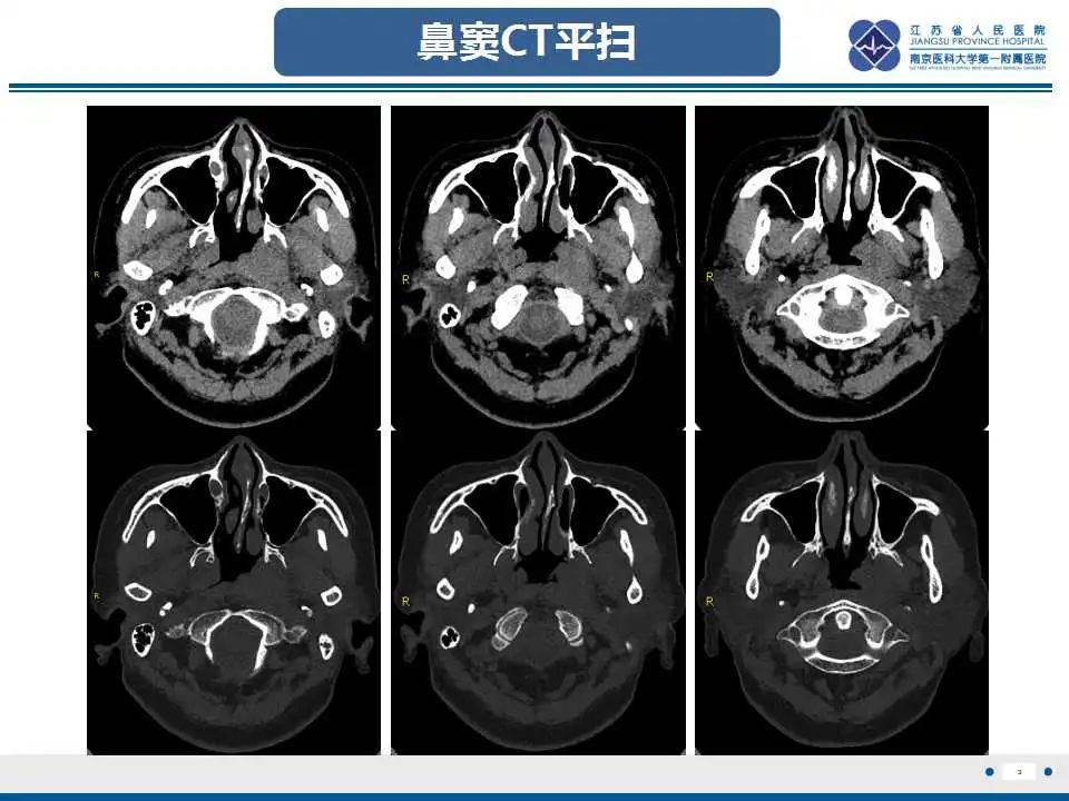 影像PPT - 【PPT】鼻咽癌-4