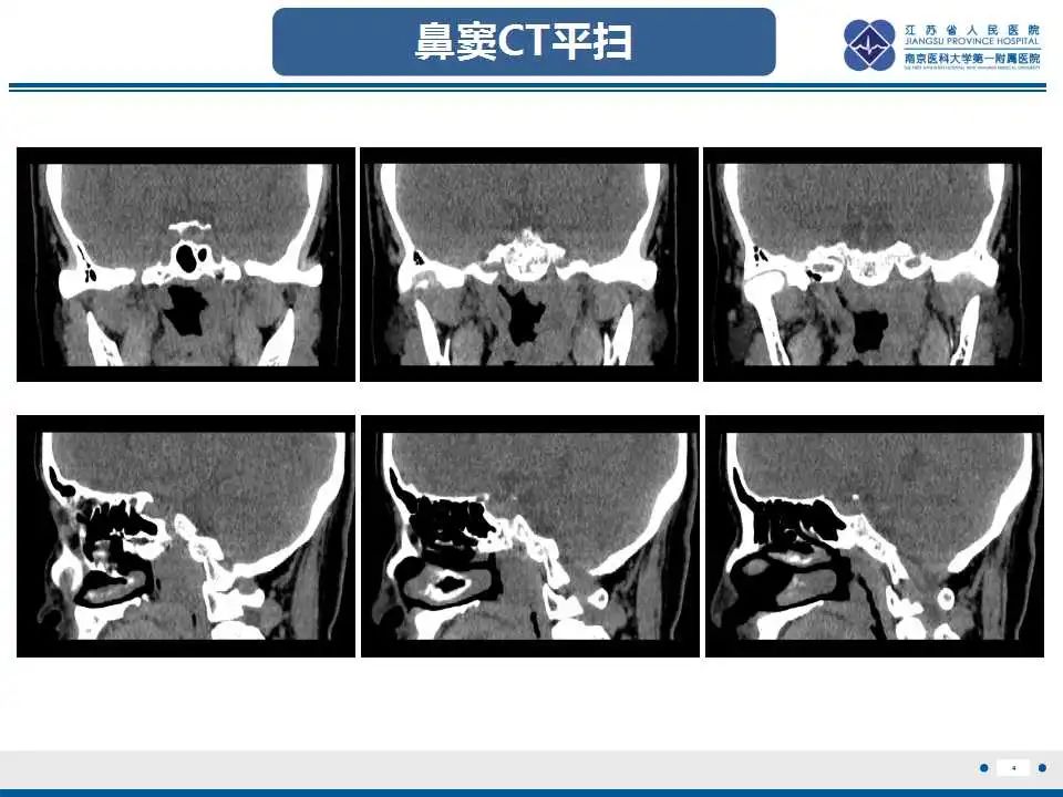 影像PPT - 【PPT】鼻咽癌-5