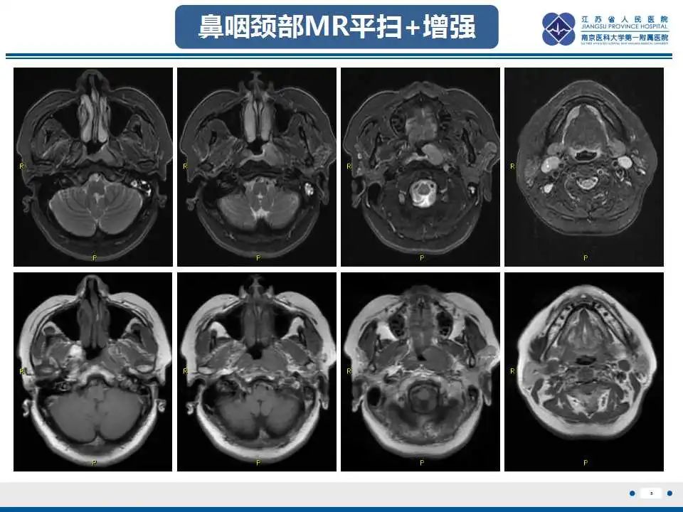 影像PPT - 【PPT】鼻咽癌-6