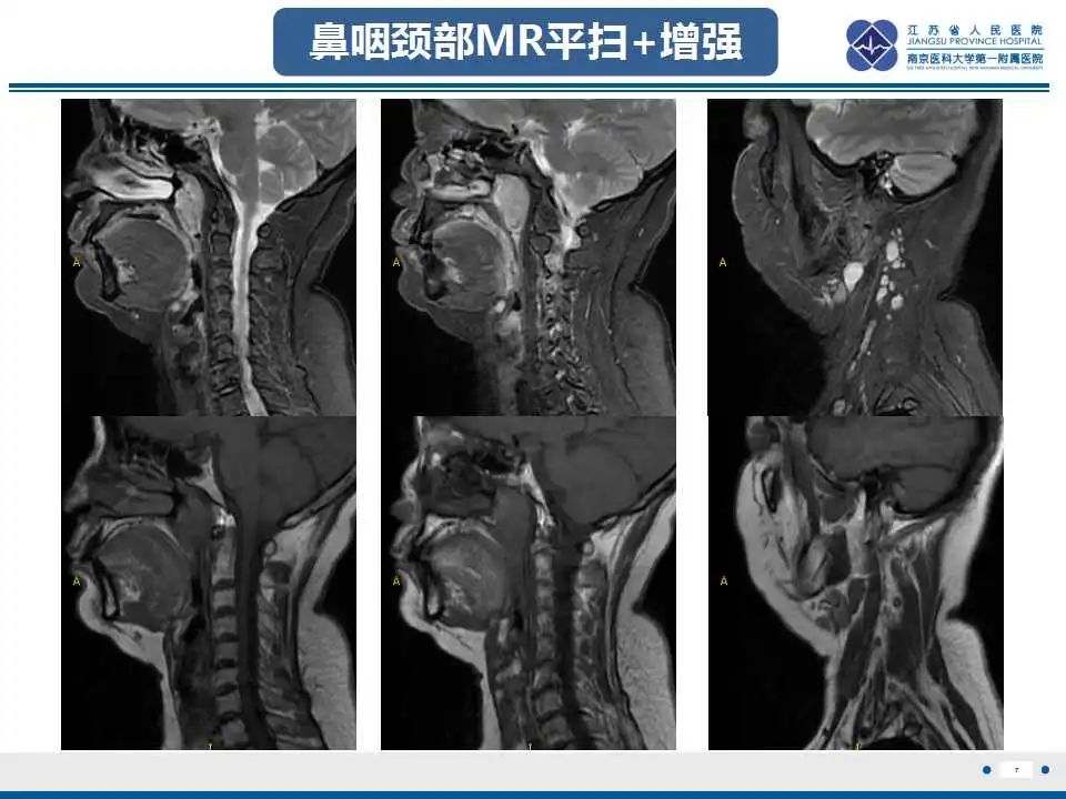 影像PPT - 【PPT】鼻咽癌-8
