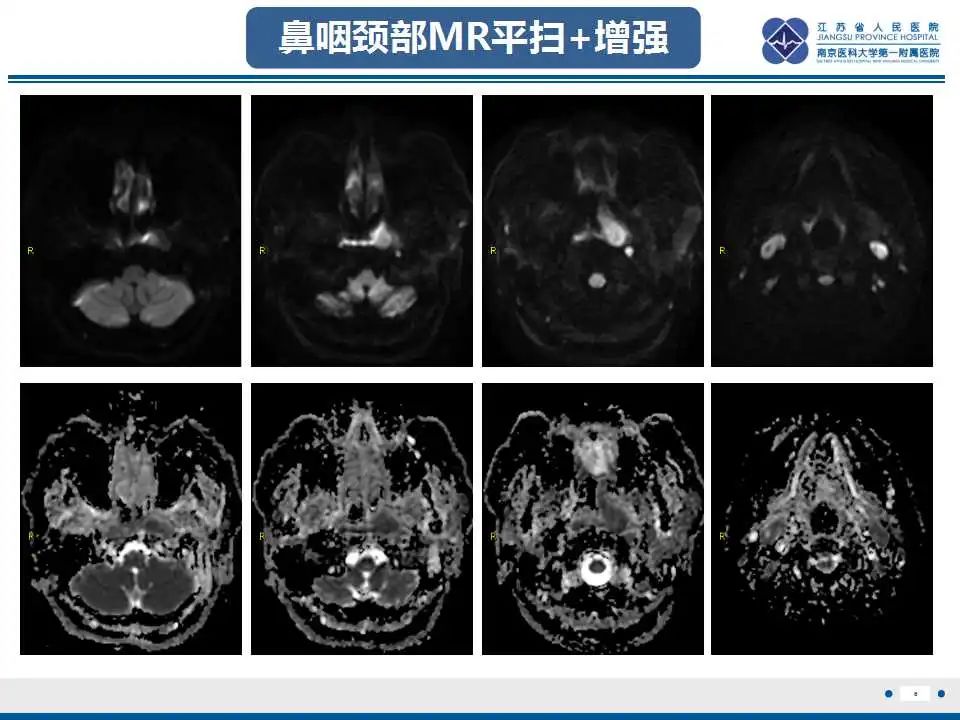 影像PPT - 【PPT】鼻咽癌-7