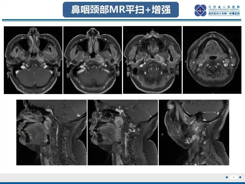 影像PPT - 【PPT】鼻咽癌-9