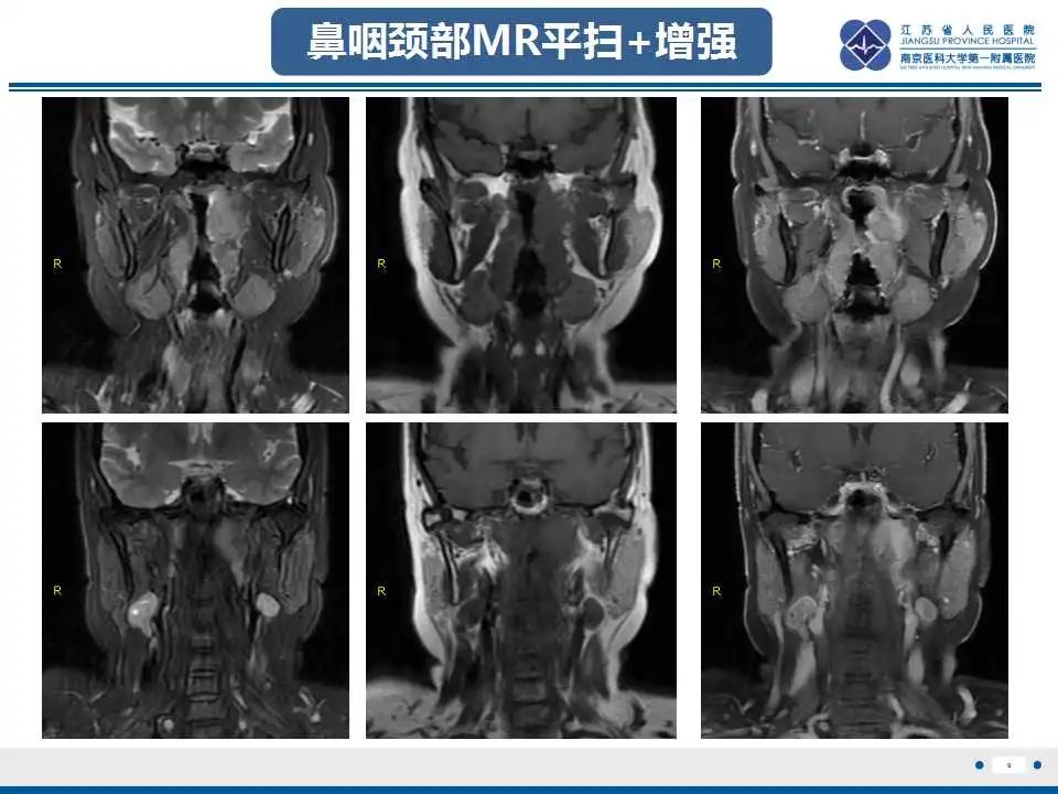 影像PPT - 【PPT】鼻咽癌-10