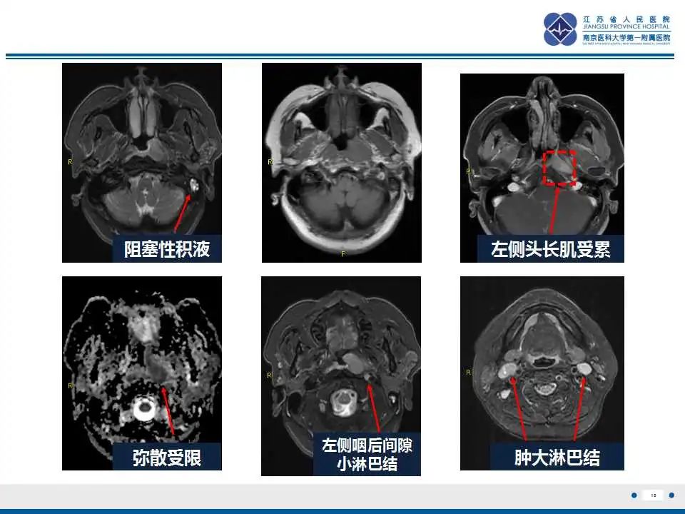 影像PPT - 【PPT】鼻咽癌-16