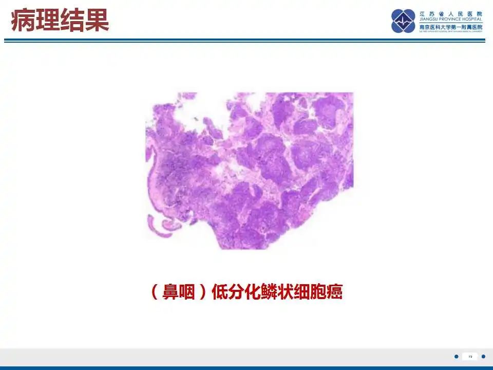 影像PPT - 【PPT】鼻咽癌-20