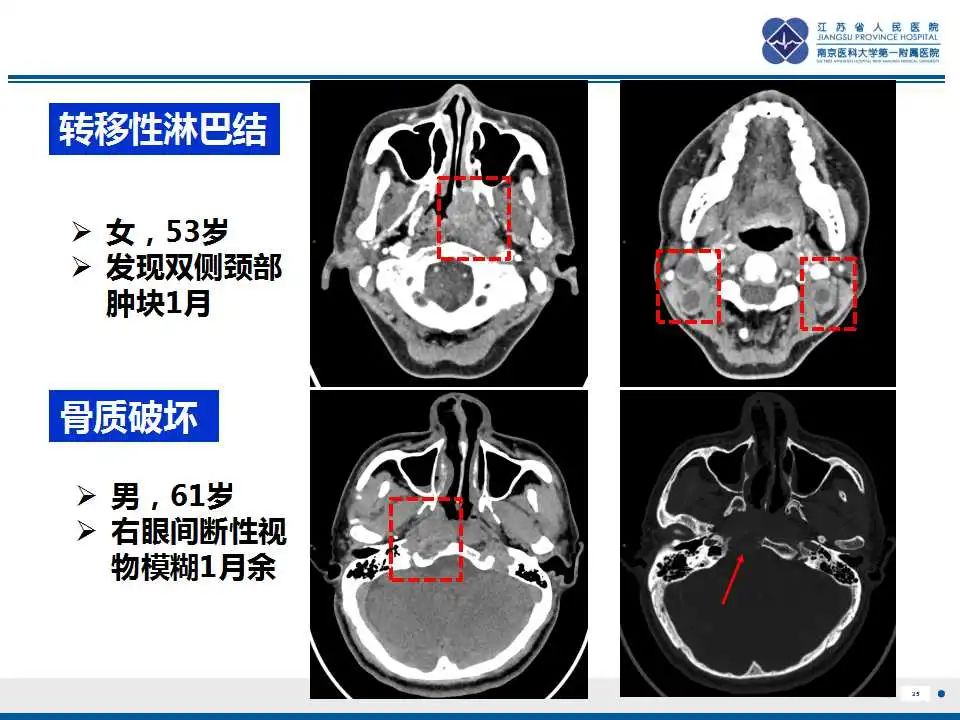 影像PPT - 【PPT】鼻咽癌-26