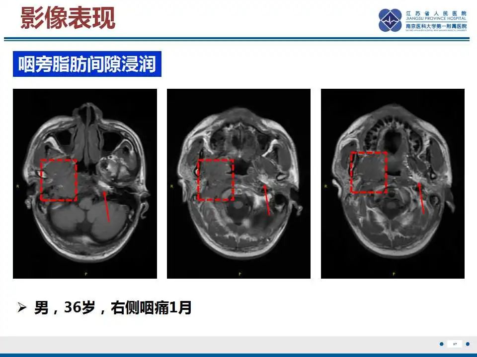 影像PPT - 【PPT】鼻咽癌-28