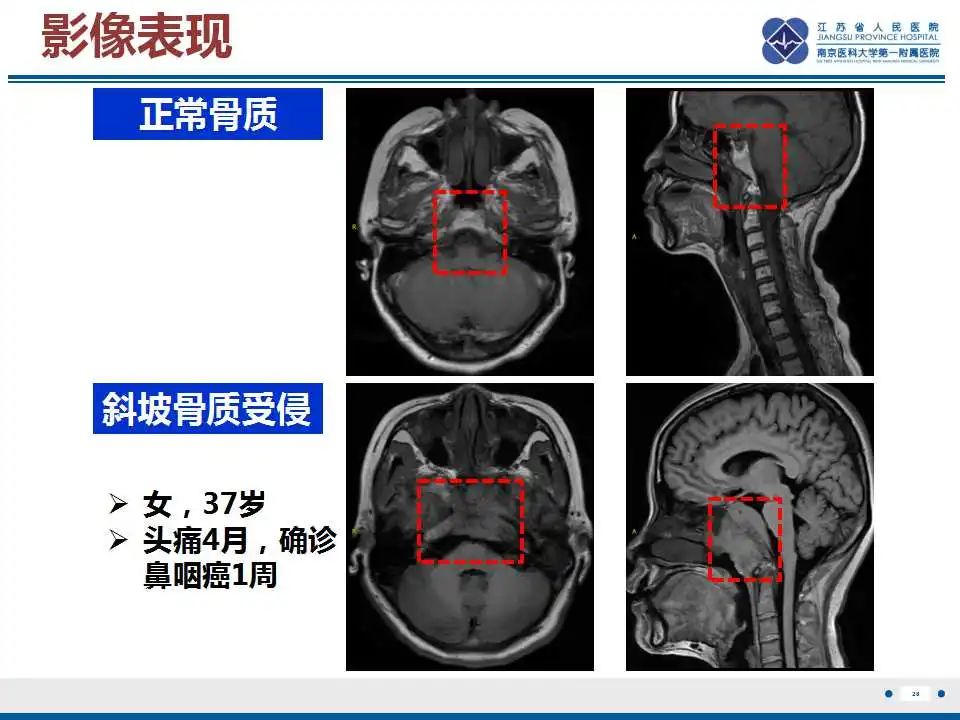 影像PPT - 【PPT】鼻咽癌-29