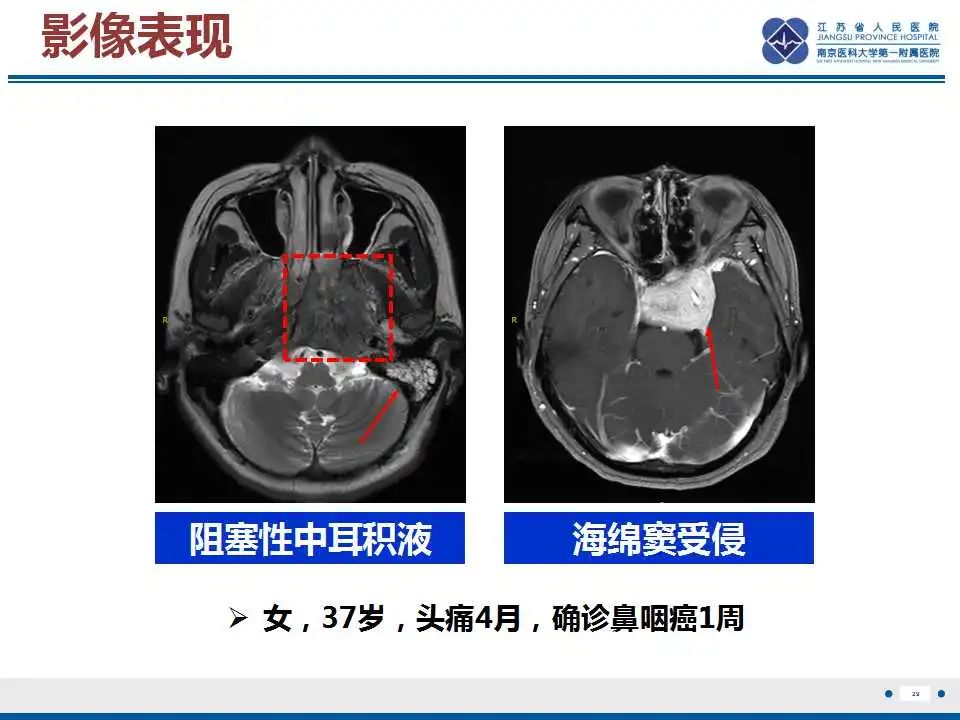 影像PPT - 【PPT】鼻咽癌-30