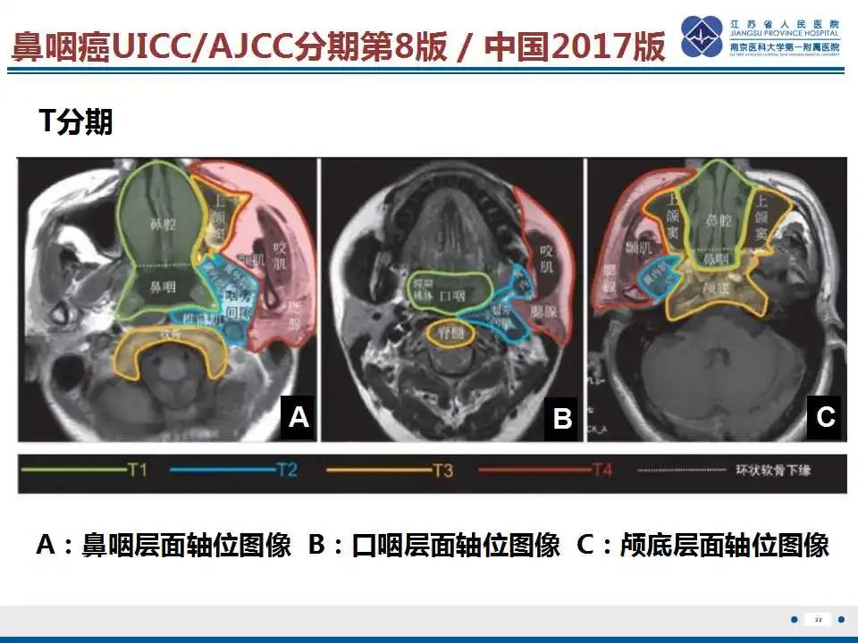 影像PPT - 【PPT】鼻咽癌-33
