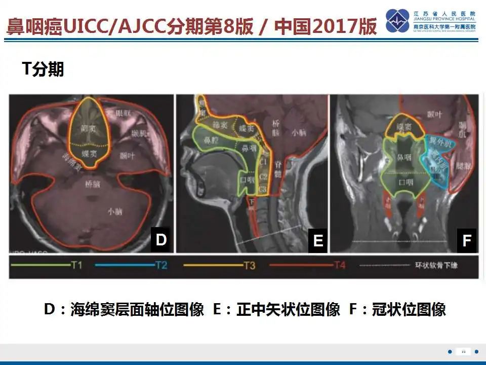 影像PPT - 【PPT】鼻咽癌-34