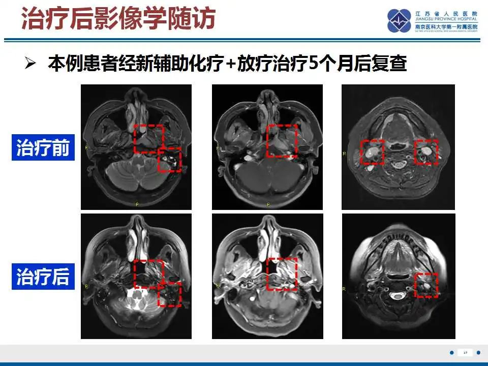 影像PPT - 【PPT】鼻咽癌-38