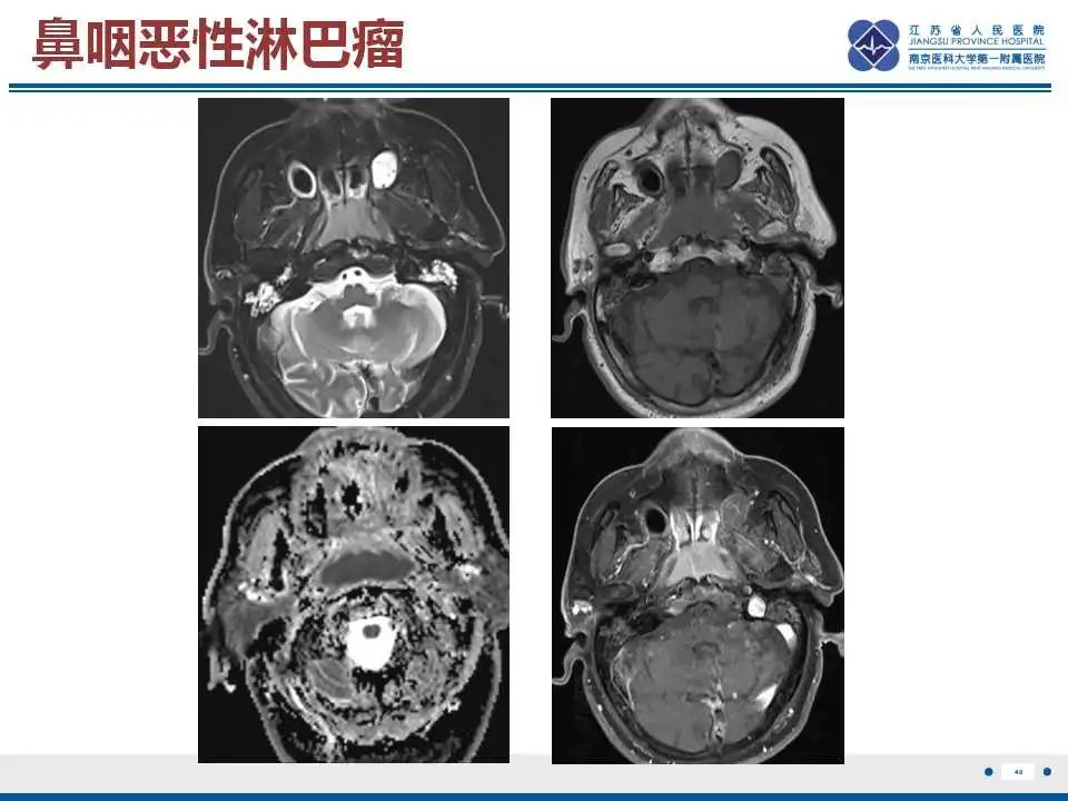影像PPT - 【PPT】鼻咽癌-41