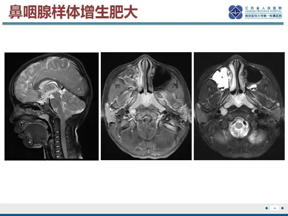 影像PPT - 【PPT】鼻咽癌-43