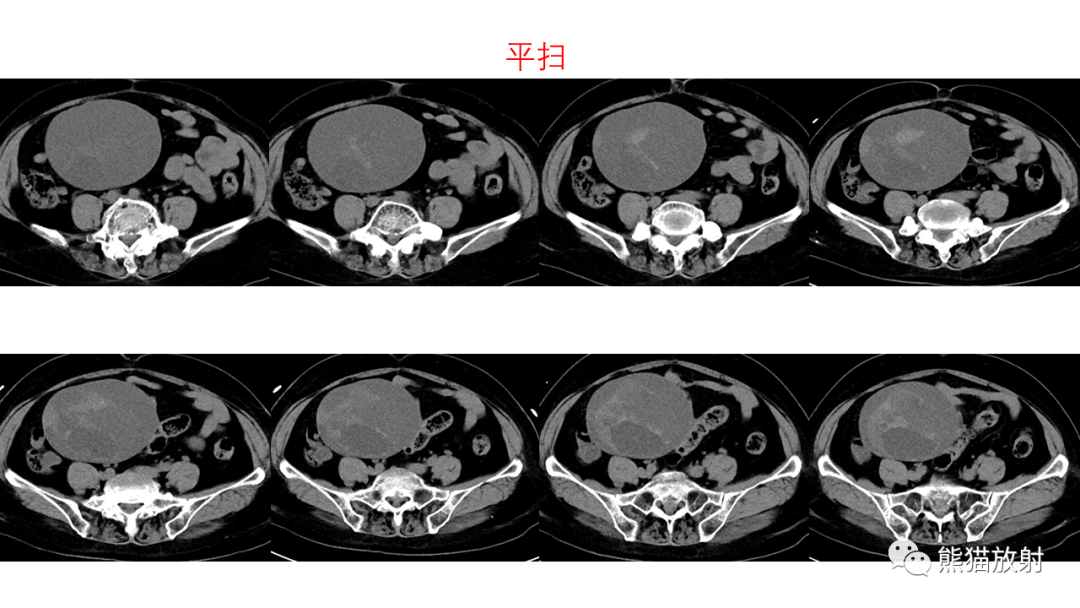 影像PPT - 【PPT】卵巢粘液性囊腺瘤 VS 浆液性囊腺瘤-4