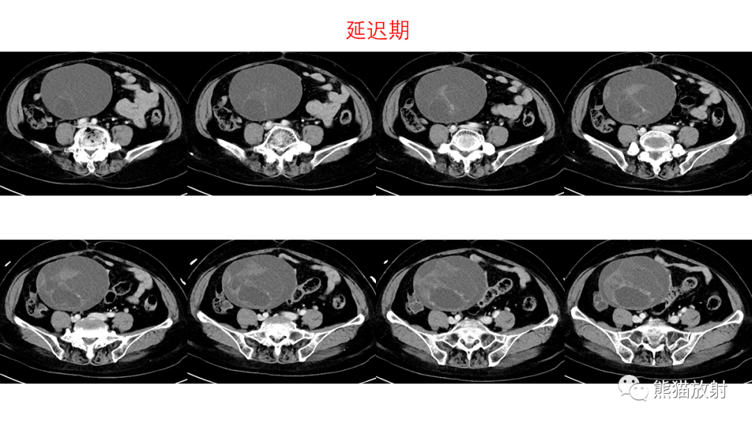 影像PPT - 【PPT】卵巢粘液性囊腺瘤 VS 浆液性囊腺瘤-10