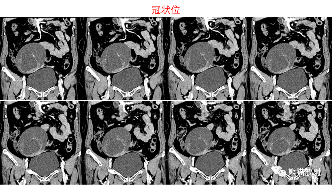影像PPT - 【PPT】卵巢粘液性囊腺瘤 VS 浆液性囊腺瘤-12