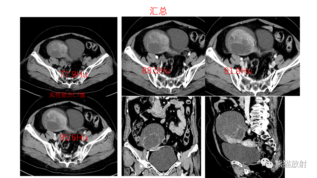 影像PPT - 【PPT】卵巢粘液性囊腺瘤 VS 浆液性囊腺瘤-14