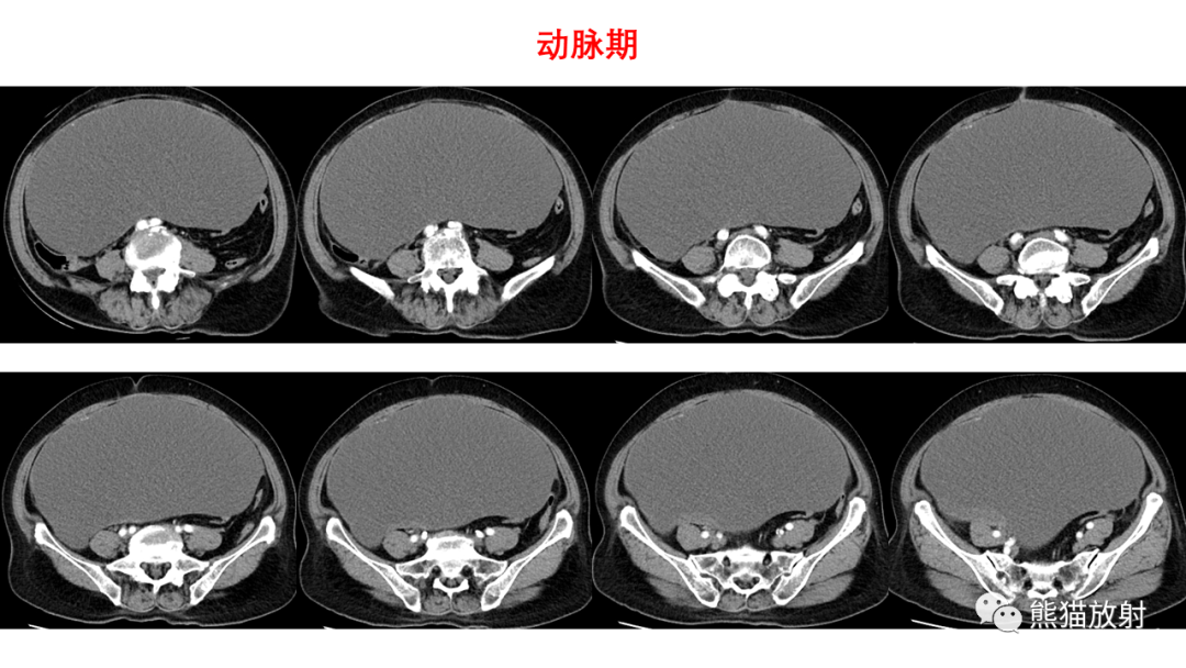 影像PPT - 【PPT】卵巢粘液性囊腺瘤 VS 浆液性囊腺瘤-20