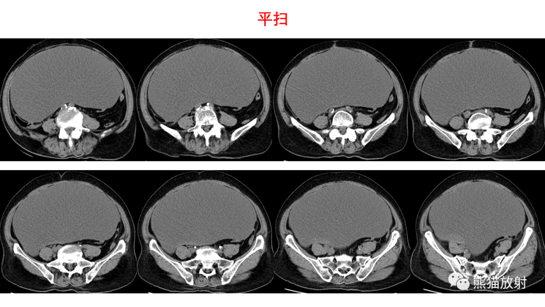 影像PPT - 【PPT】卵巢粘液性囊腺瘤 VS 浆液性囊腺瘤-18