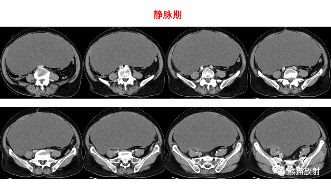 影像PPT - 【PPT】卵巢粘液性囊腺瘤 VS 浆液性囊腺瘤-22
