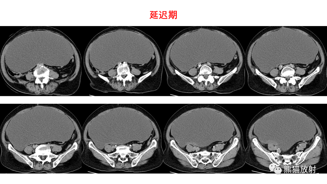 影像PPT - 【PPT】卵巢粘液性囊腺瘤 VS 浆液性囊腺瘤-24