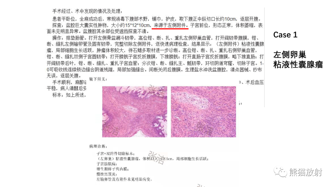 影像PPT - 【PPT】卵巢粘液性囊腺瘤 VS 浆液性囊腺瘤-29