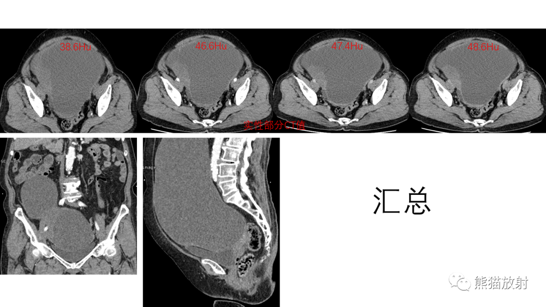 影像PPT - 【PPT】卵巢粘液性囊腺瘤 VS 浆液性囊腺瘤-28