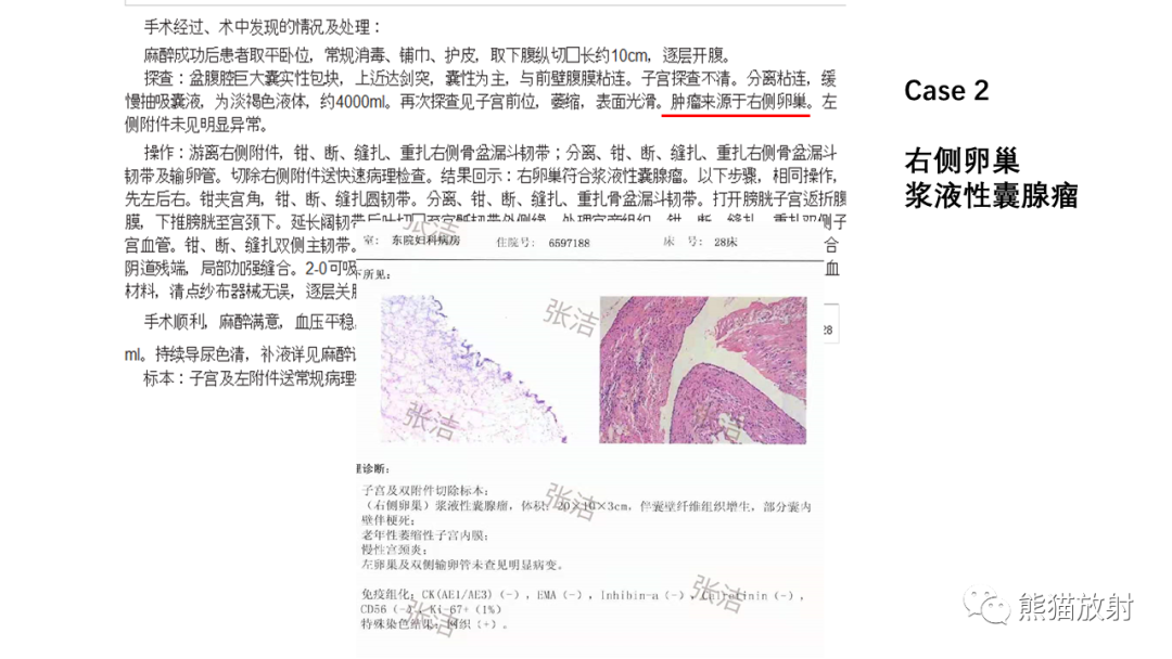 影像PPT - 【PPT】卵巢粘液性囊腺瘤 VS 浆液性囊腺瘤-30