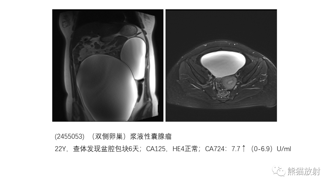 影像PPT - 【PPT】卵巢粘液性囊腺瘤 VS 浆液性囊腺瘤-34