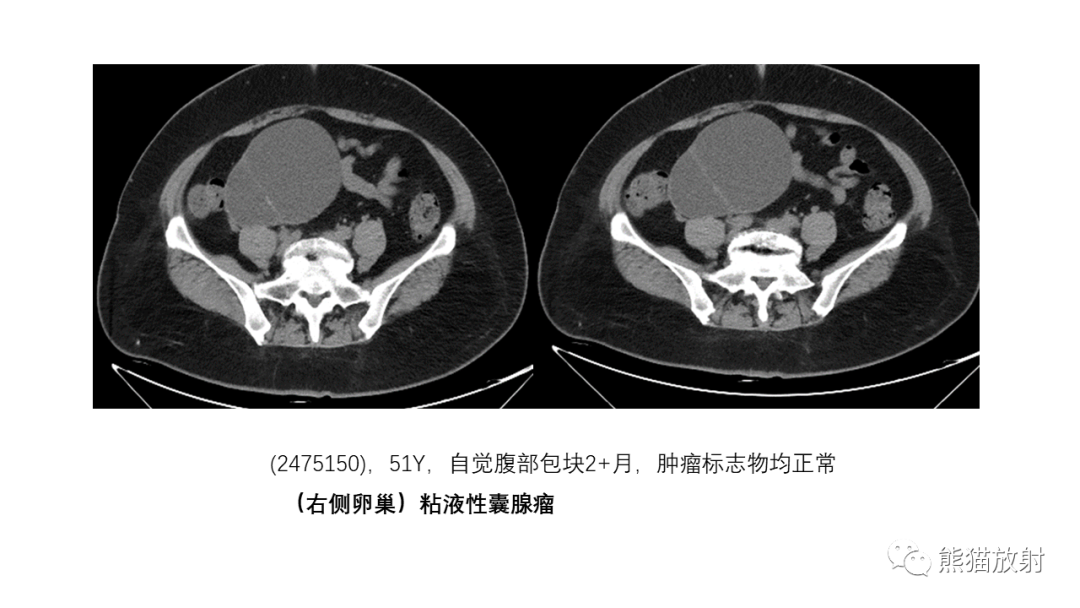 影像PPT - 【PPT】卵巢粘液性囊腺瘤 VS 浆液性囊腺瘤-38