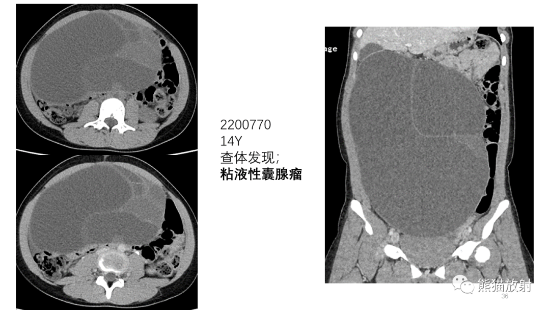 影像PPT - 【PPT】卵巢粘液性囊腺瘤 VS 浆液性囊腺瘤-37