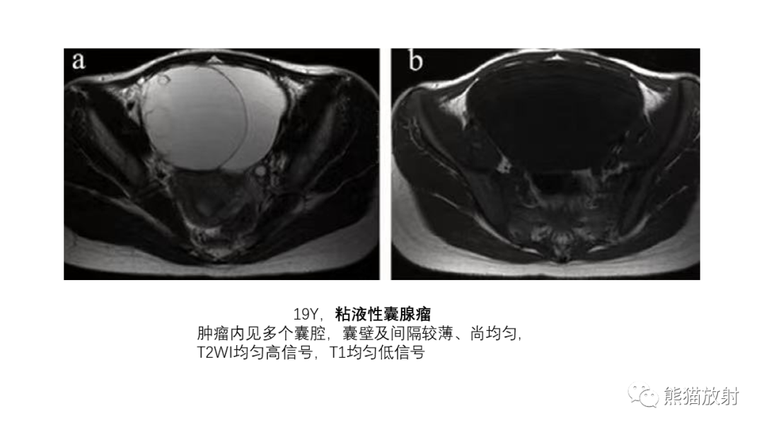 影像PPT - 【PPT】卵巢粘液性囊腺瘤 VS 浆液性囊腺瘤-39