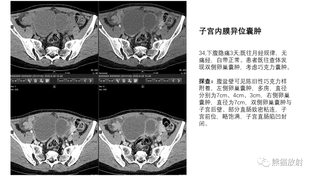 影像PPT - 【PPT】卵巢粘液性囊腺瘤 VS 浆液性囊腺瘤-43