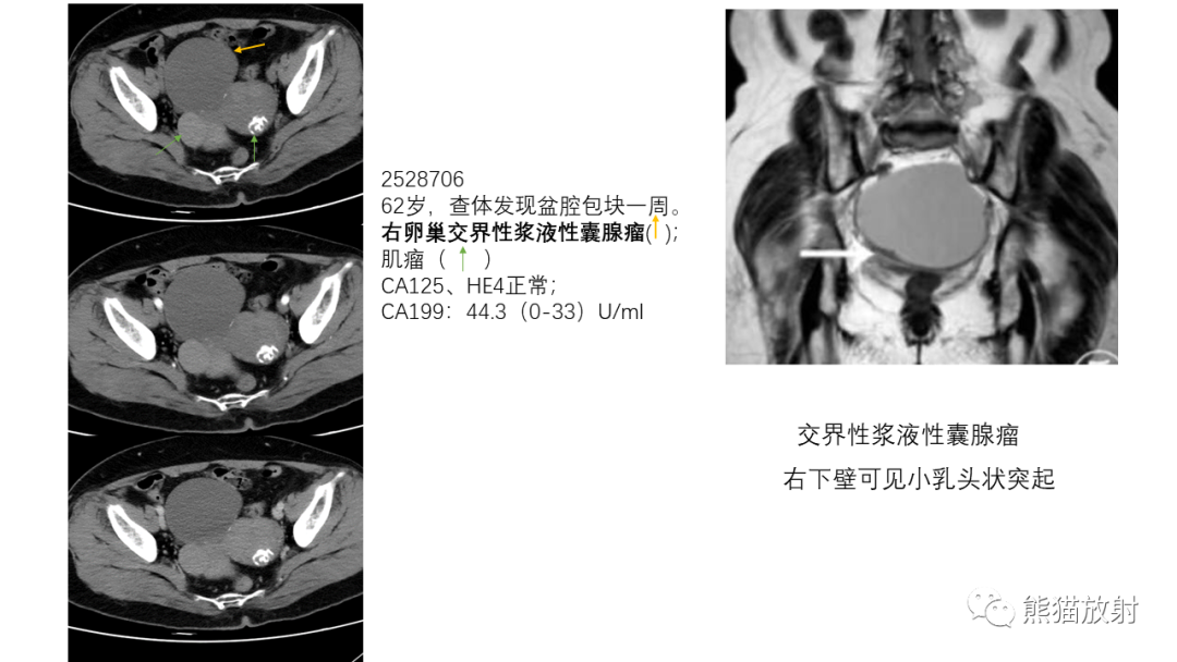 影像PPT - 【PPT】卵巢粘液性囊腺瘤 VS 浆液性囊腺瘤-41