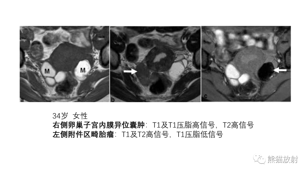 影像PPT - 【PPT】卵巢粘液性囊腺瘤 VS 浆液性囊腺瘤-46